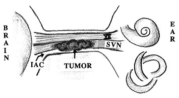 acousticneuroma.jpg