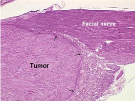 acousticneuroma2.jpg