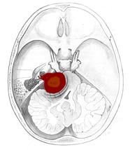 acousticneuromalarge10.jpg