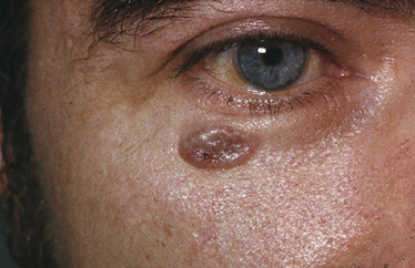 basalcellcarcinoma01.jpg