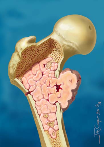 chondrosarcoma.jpg