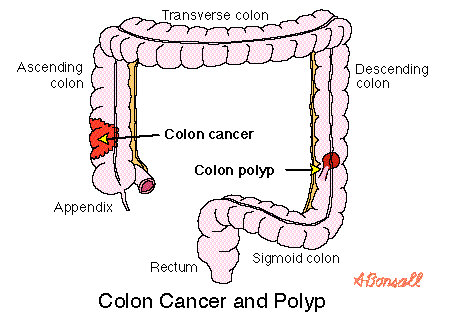 coloncancerandpolyp.gif