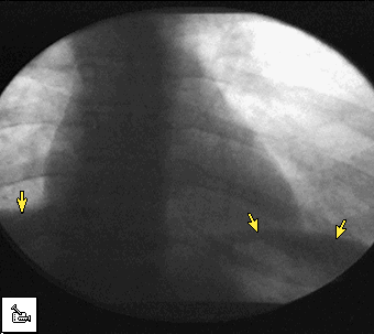 fluoroscopyflodiapL.gif