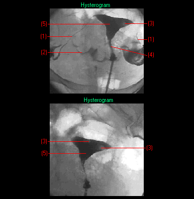 hysterographyaa85.gif