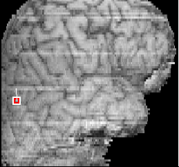 magnetoencephalographyimg00009.gif