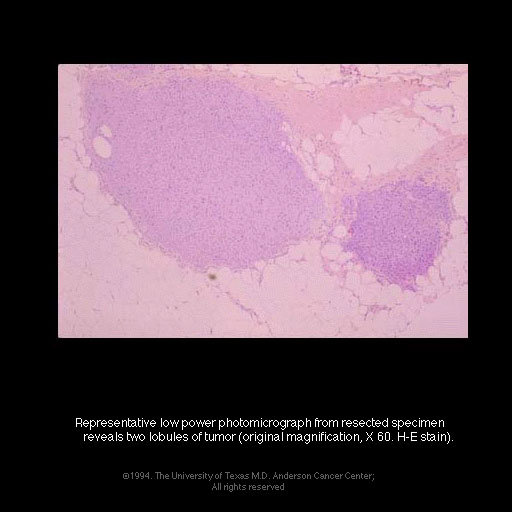 patient03chondrosarcomab.jpg